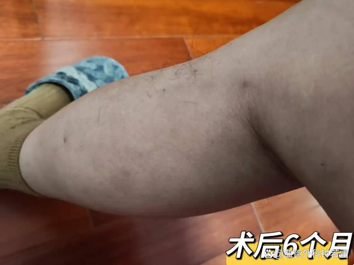 62岁静脉曲张，独自去武汉做微创，术后半年坦言：大老远没白来！