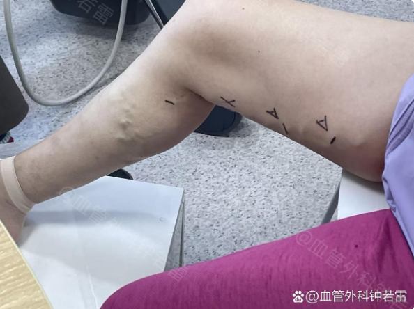江苏70岁阿姨静脉曲张，当地让等老烂腿开刀，慕名来武汉微创