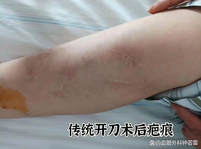 静脉曲张微创恢复期长吗，多久可以回归正常生活？一篇文章说明白