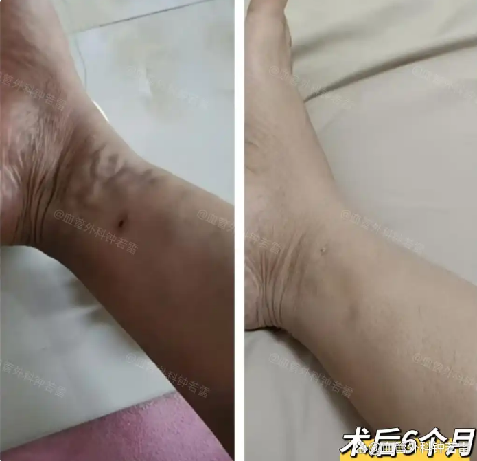 静脉曲张微创恢复期长吗，多久可以回归正常生活？一篇文章说明白