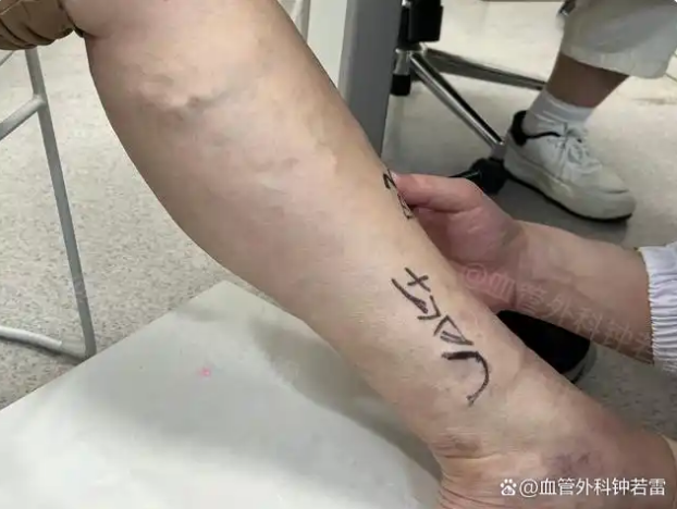 「静脉曲张案例79」腿痒胀疼走不动路，30分钟微创摆脱无形枷锁