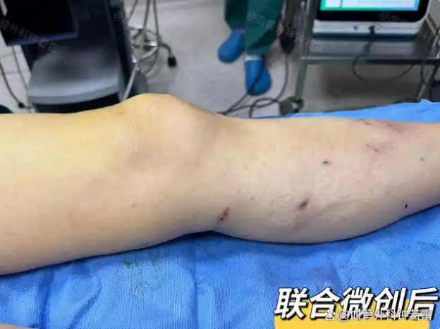 「静脉曲张案例79」腿痒胀疼走不动路，30分钟微创摆脱无形枷锁