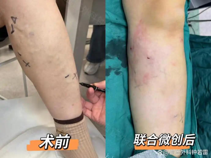 安徽59岁大姐静脉曲张，和朋友跨省来做微创，术后笑容藏不住了