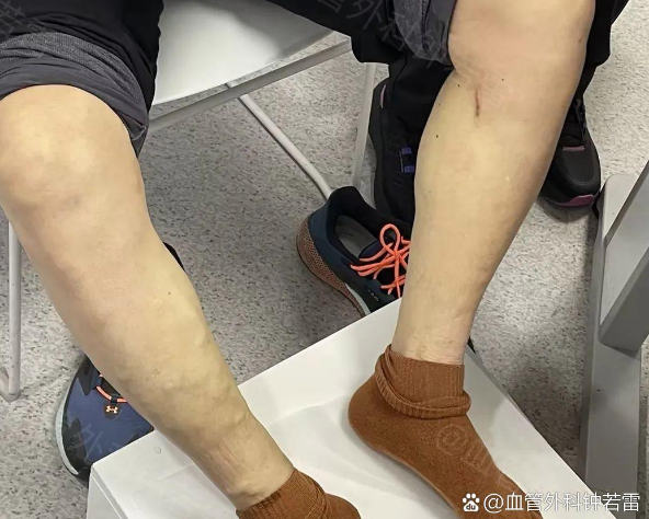 辽宁57岁大哥静脉曲张，害怕开刀不敢治疗，微创后观念大转变