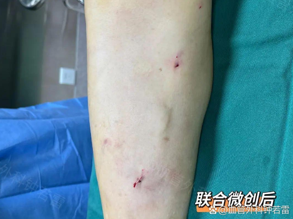 辽宁57岁大哥静脉曲张，害怕开刀不敢治疗，微创后观念大转变