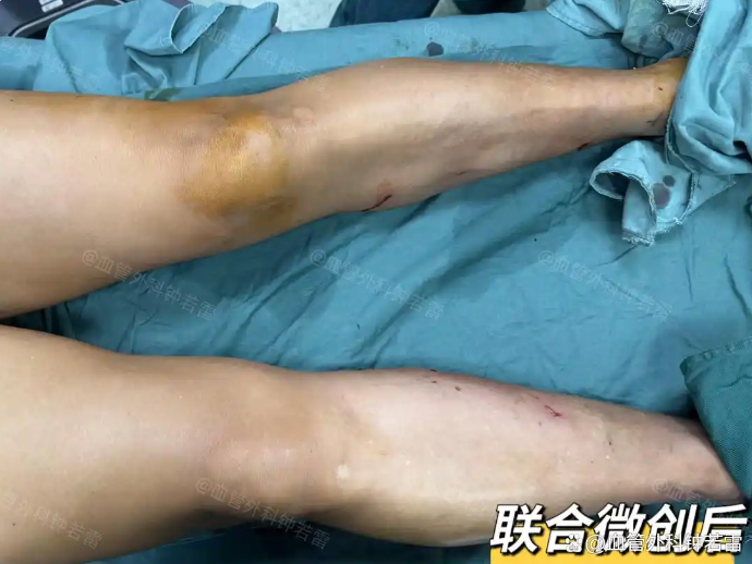 「静脉曲张案例80」腿胀发沉到跑半程马拉松，65岁大叔经历了什么