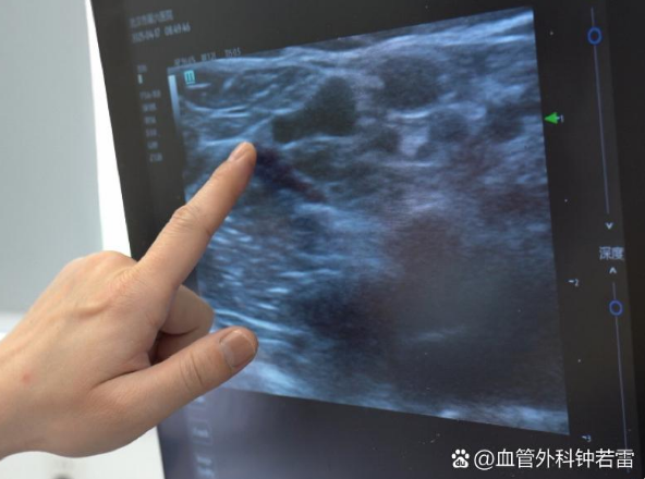 58岁麻醉医生静脉曲张，腿上发红不敢穿裙子，微创术后放心过夏天