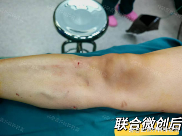 58岁麻醉医生静脉曲张，腿上发红不敢穿裙子，微创术后放心过夏天