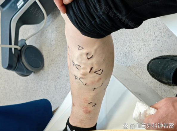 42岁静脉曲张，慕名到武汉做联合微创，说说我的真实感受