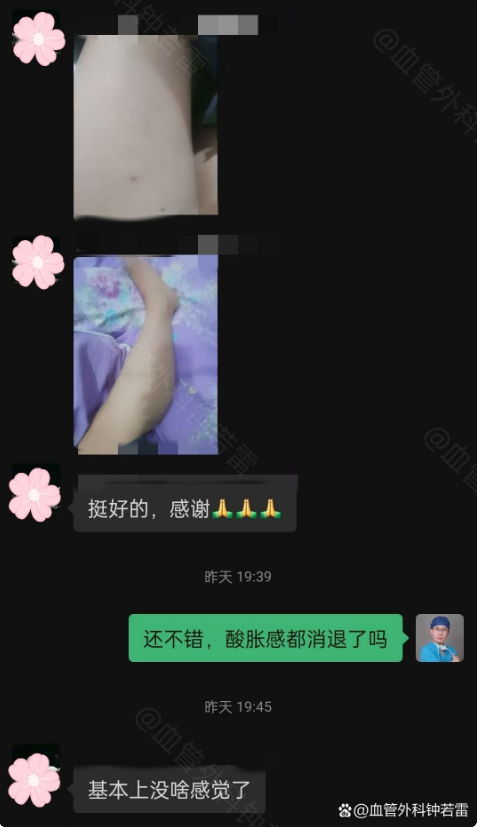 曲张血管像“树根”蔓延到大腿，山东大姐微创术后半年，重获轻盈双腿