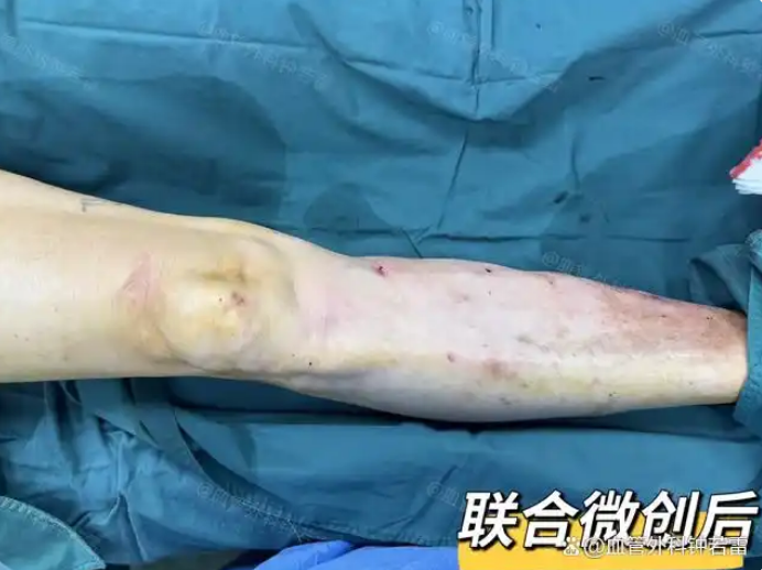 62岁退休教师静脉曲张，不疼不痒突然长血栓，微创治疗一并解决