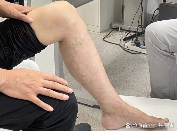 61岁鼓起勇气，去做静脉曲张微创局麻手术，说说我术中的真实感受