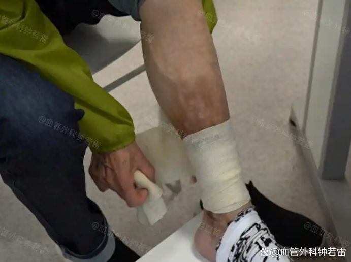 「静脉曲张案例81」甘肃69岁阿姨腿像“生了锈”，病因竟如此常见