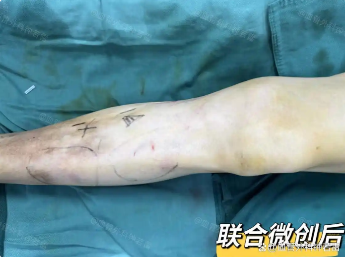 「静脉曲张案例81」甘肃69岁阿姨腿像“生了锈”，病因竟如此常见