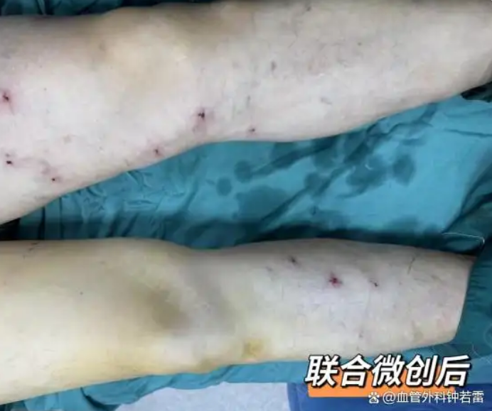 穿弹力袜3年反加重？皮肤变黑=血管在求救！这类静脉曲张尽早治疗