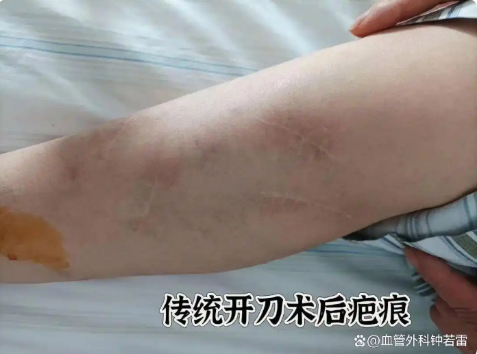 夏天能不能做静脉曲张手术？看完这篇文章就明白了