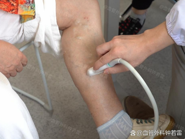 退休后做了个大胆决定，独自去做静脉曲张微创，180天后说实话有点后悔！