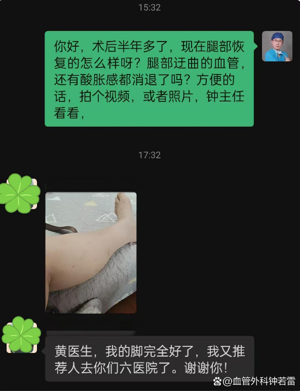 退休后做了个大胆决定，独自去做静脉曲张微创，180天后说实话有点后悔！