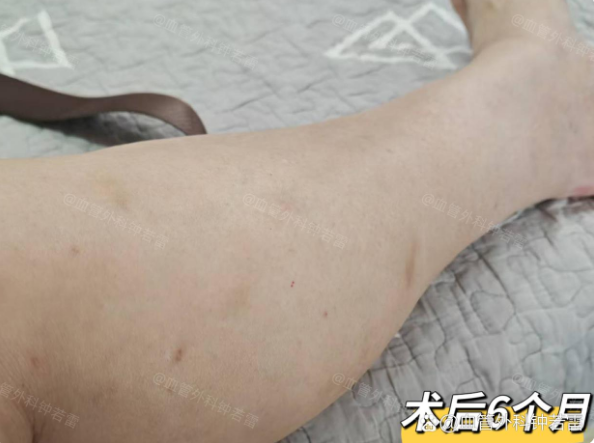 退休后做了个大胆决定，独自去做静脉曲张微创，180天后说实话有点后悔！