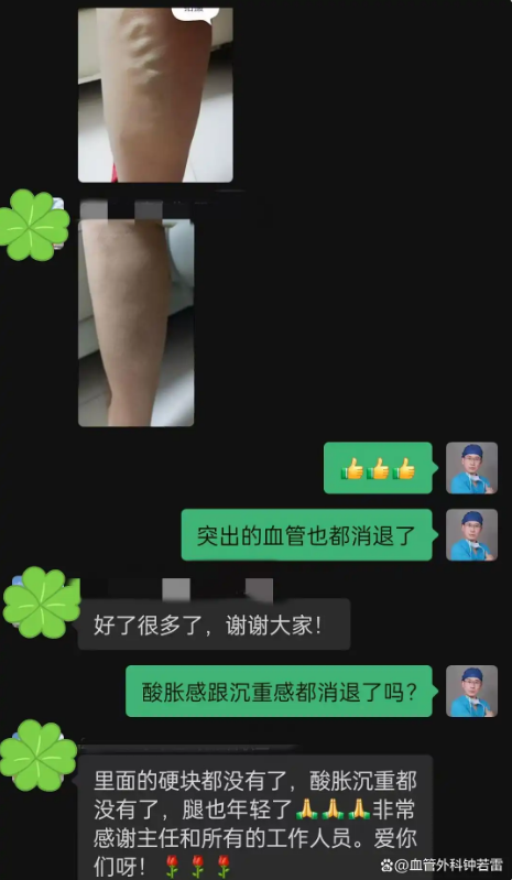 53岁，做完静脉曲张微创6个月，不想隐瞒坦白4点真相！