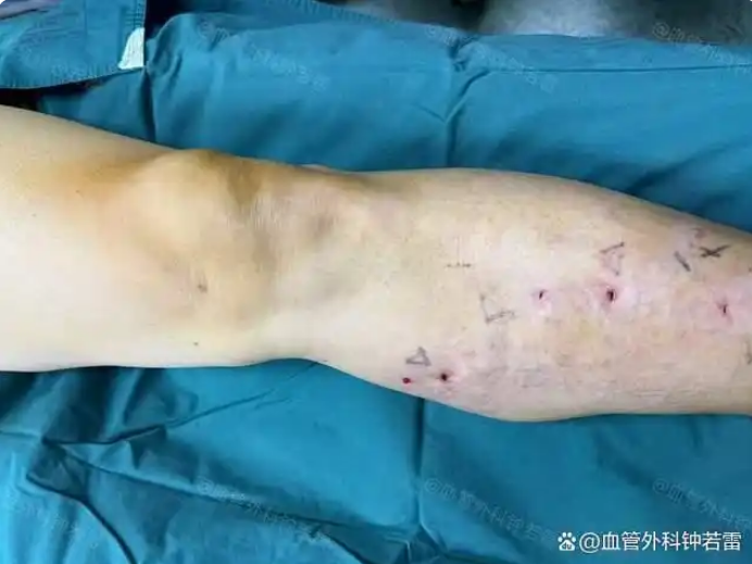 50岁一时心动，到武汉做了静脉曲张微创，没想到效果出乎意料！