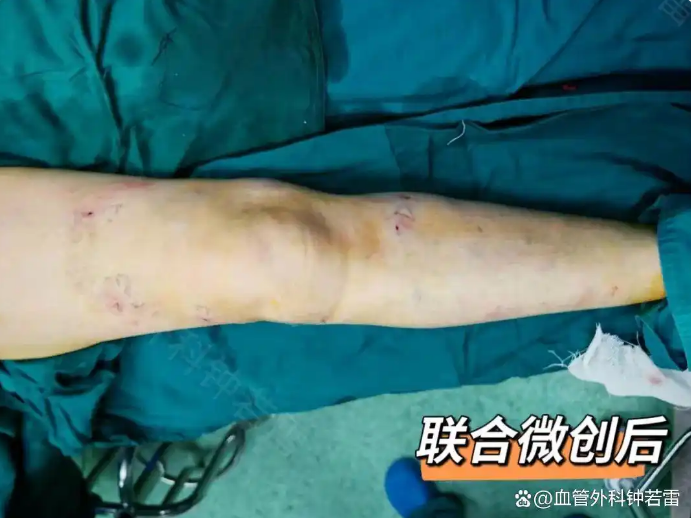 71岁静脉曲张，没开刀没遭罪，花了30分钟摆脱半辈子的困扰