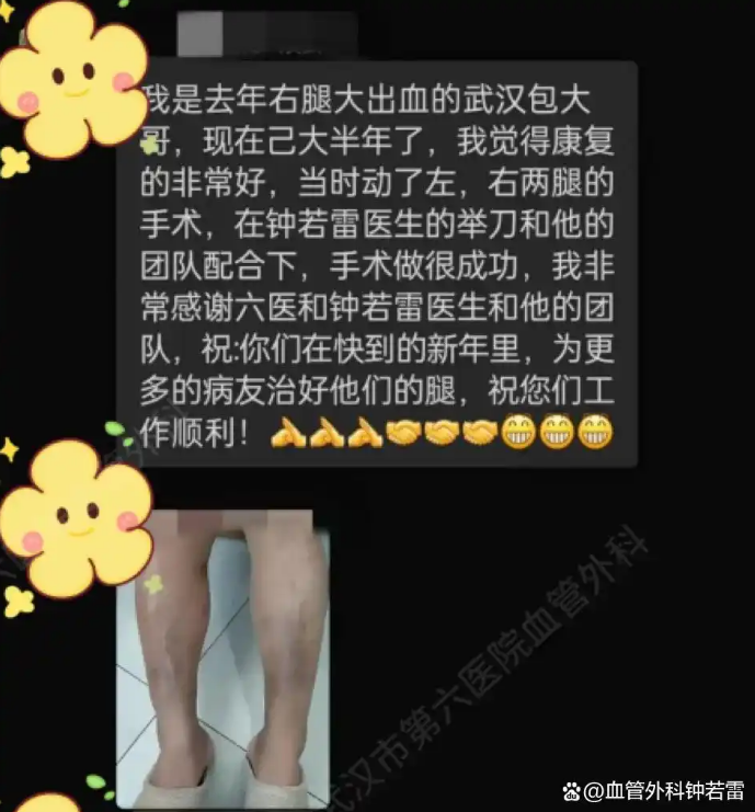 静脉溃疡小腿破裂喷血，武汉大哥术后8个月复诊，后续来了！