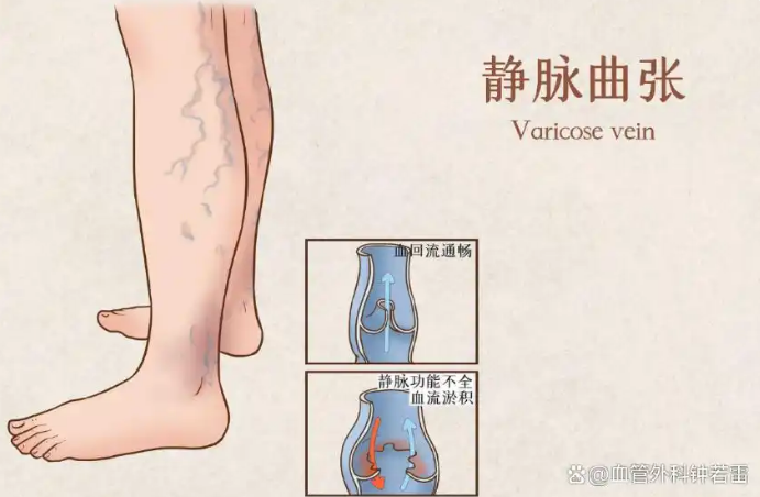 退休后向静脉曲张发起总攻，给同龄人打个样