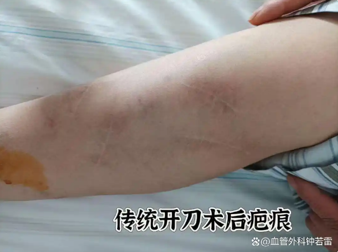 退休后向静脉曲张发起总攻，给同龄人打个样