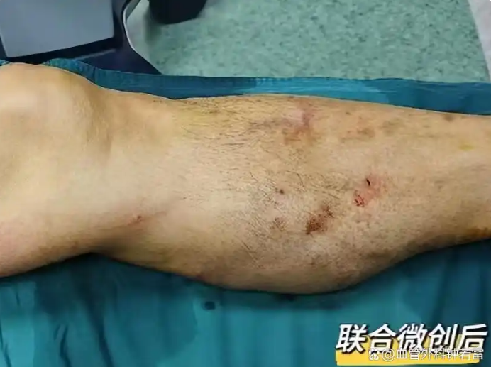 61岁西班牙华侨，花一个月退休工资，回国30分钟治好多年静脉曲张