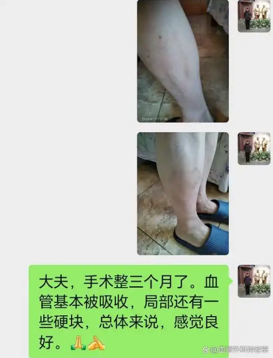 静脉曲张微创术后100天，决定公布一些真相，只有过来人才知道！
