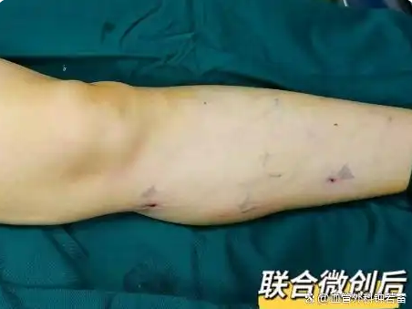 甘肃53岁教师静脉曲张，30分钟联合微创后，夏天终于敢自信穿裙子