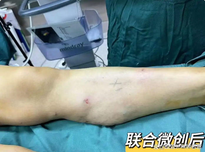 47岁静脉曲张，走过的弯路过于真实，分享亲身经历帮大家避坑
