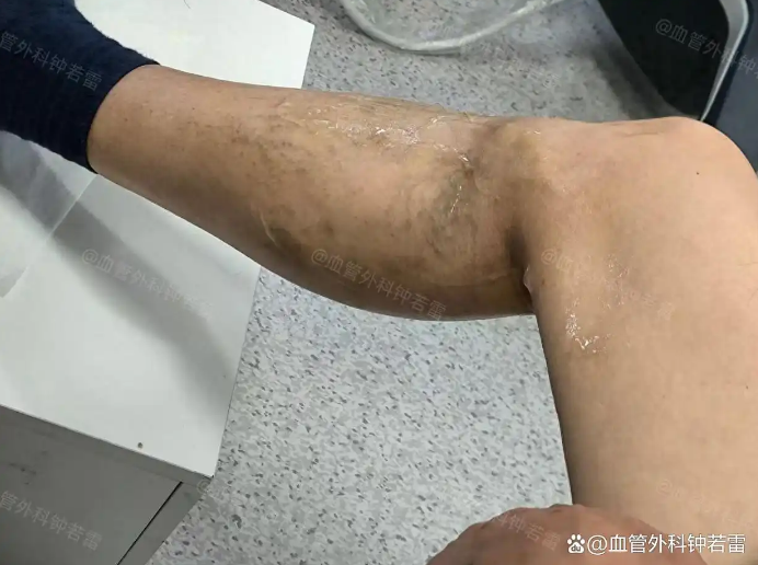 66岁没忍住，独自到武汉做静脉曲张微创，半年后的状态出乎意料