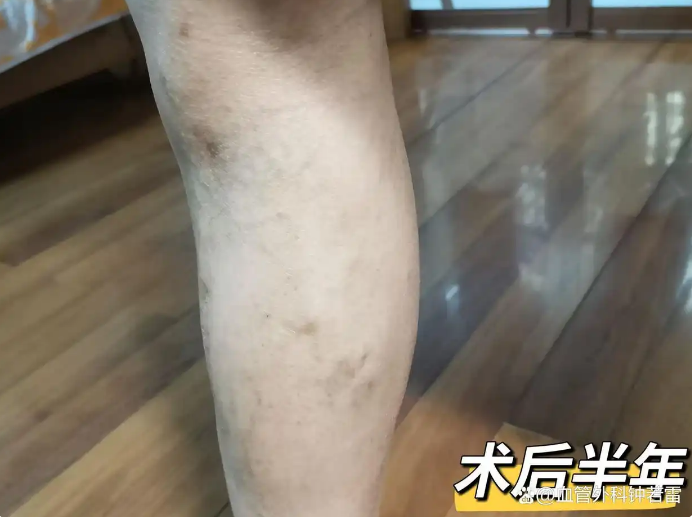 66岁没忍住，独自到武汉做静脉曲张微创，半年后的状态出乎意料