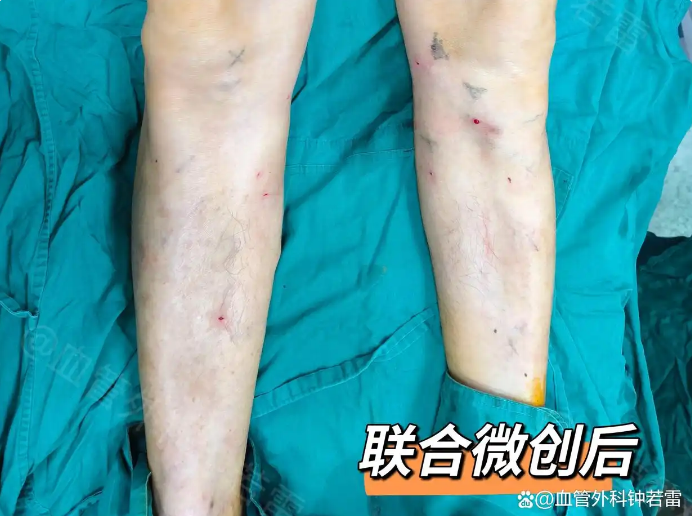 老工友一句话点醒：静脉曲张不用开刀！63岁大叔微创后放心带孙子