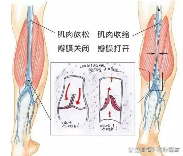 静脉曲张答疑篇：运动多了，会不会加重静脉曲张？