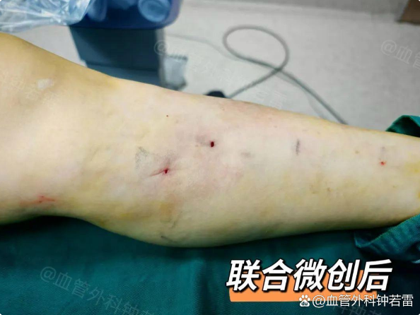河南42岁女士静脉曲张，腿瘙痒难耐，联合微创手术解除困扰