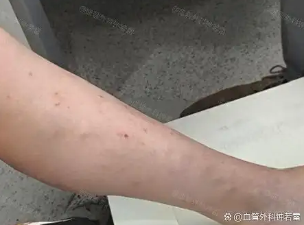 45岁来武汉治疗静脉曲张，亲身经历讲述，微创到底是什么体验？