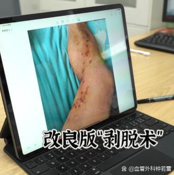同样是静脉曲张微创手术，为何恢复效果差异这么大？