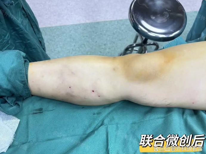 「静脉曲张案例77」腿上血管往大腿蔓延，甘肃54岁大姐一下慌了