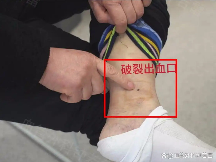 热水泡脚引发静脉破裂出血?3步急救法关键时刻能救命