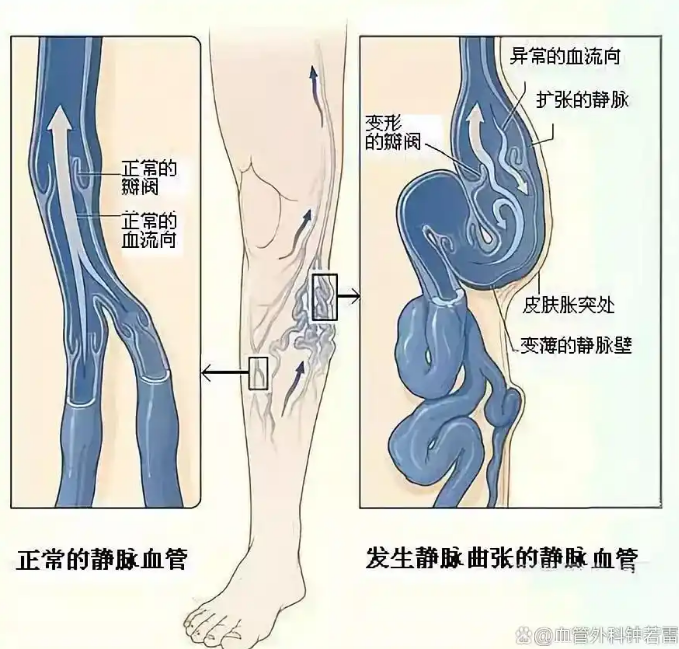 热水泡脚引发静脉破裂出血？3步急救法关键时刻能救命