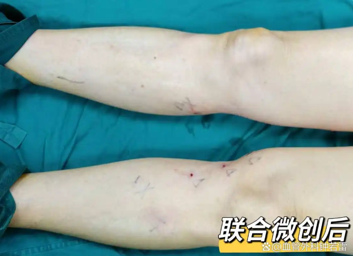 湖北90岁老奶奶静脉曲张，腿痒腿疼影响生活，微创后公园放心锻炼