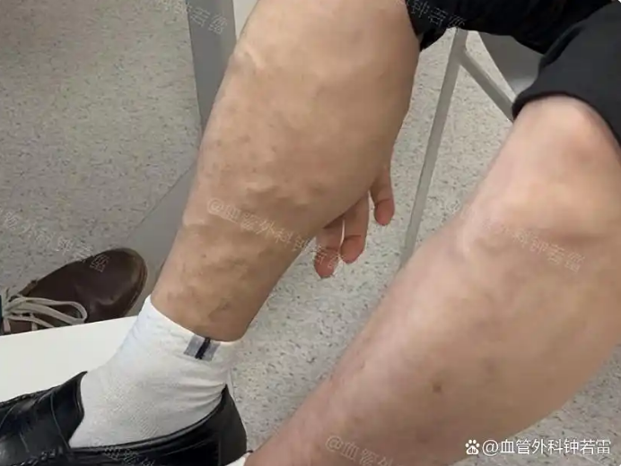 不顾家人反对！42岁先生做了静脉曲张微创，2周后找回从前的热爱