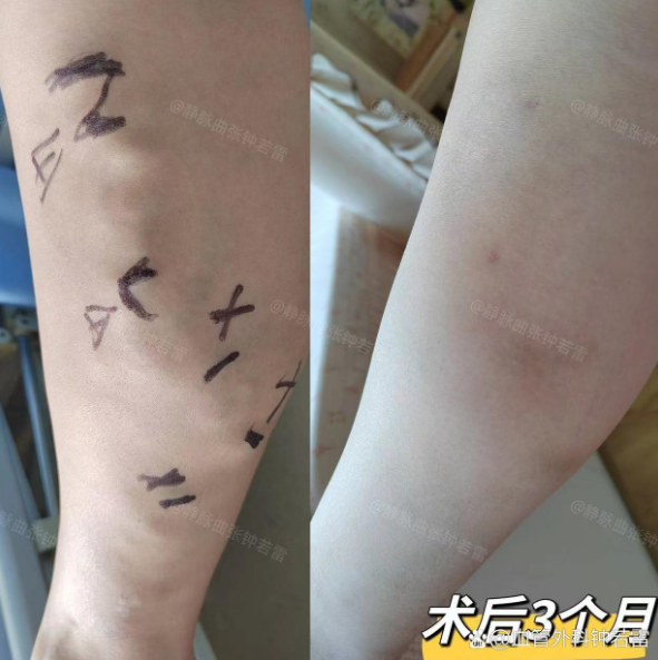静脉曲张治疗也有很多门道，一般医生不会告诉你，这里面的真相