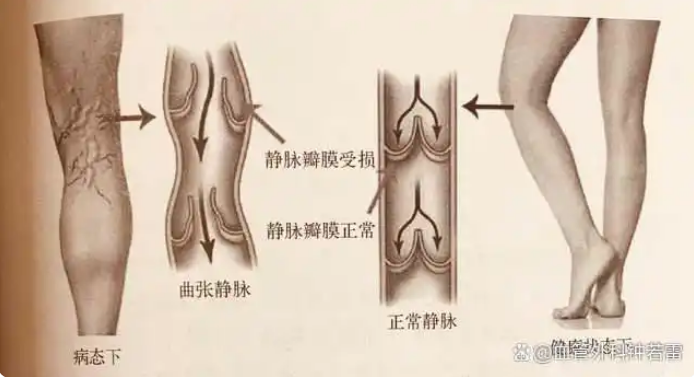 孩子遗传了父母的静脉曲张该怎么办？3个“锦囊”帮大家轻松应对