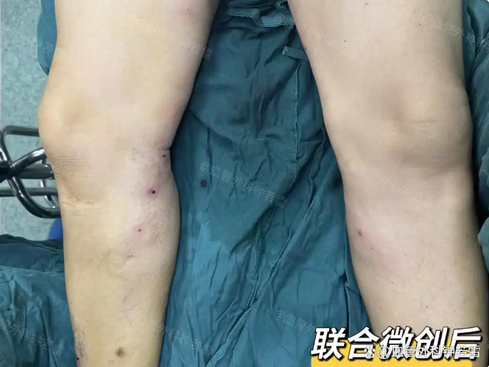 年近50岁，冒险去武汉做静脉曲张微创，术后这段经历想跟大家分享